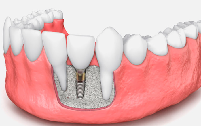 Injertos de hueso ¿Se necesitan siempre para la colocación de implantes dentales?