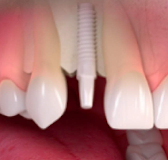 Implantes dentales Cerámicos de zirconio