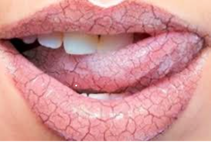 Boca seca, Xerostomía o hiposalivación. Signos, Síntomas y tratamiento de la boca seca