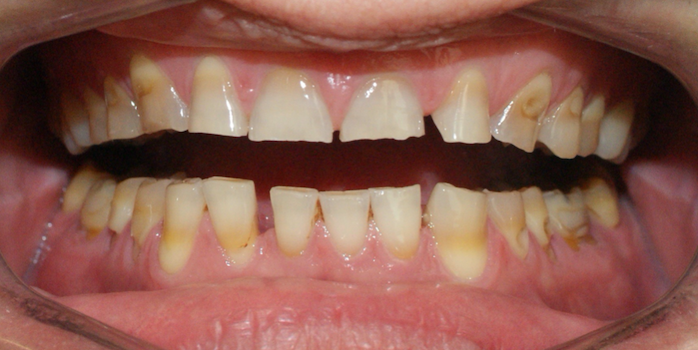 desgastes incisales-manchas de teraciclinas-ortodoncia invisible-mataro