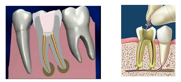 Endodóncia · DentClínic · Clínica Dental Mataró