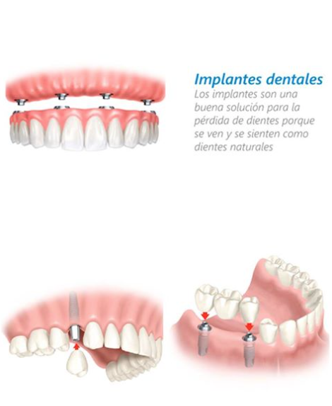 Implantes Dentales · Dentclinic · Mataró