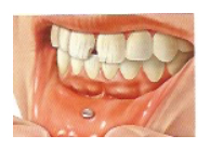 Problemática Oral Asociada al Piercing · Fisuras y Fracturas Dentales