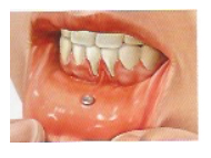 Problemática Oral Asociada al Piercing · Regresión Gingival