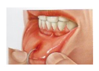 Problemática Oral Asociada al Piercing · Traumatismos