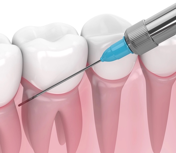 Elimina el miedo a las agujas en el dentista: Beneficios y avances de la anestesia