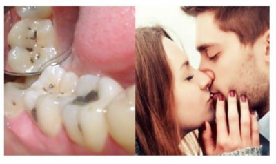 Sabías que los besos pueden contagiar las caries?