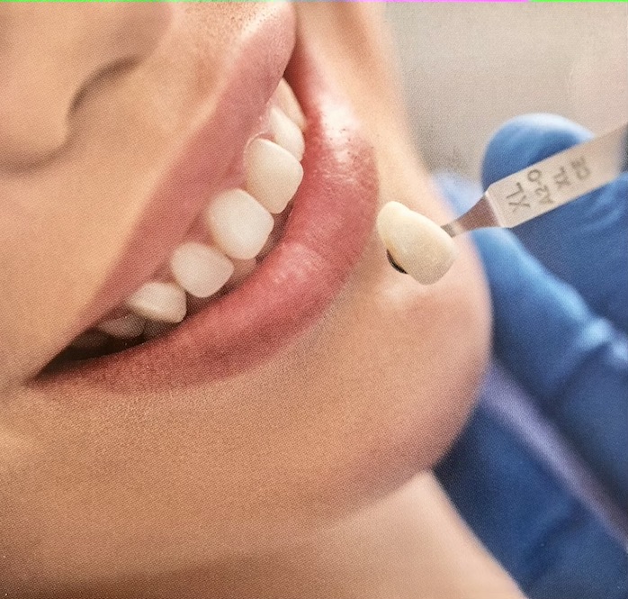 Transforme su sonrisa a la vez que mantiene la estructura natural de sus dientes