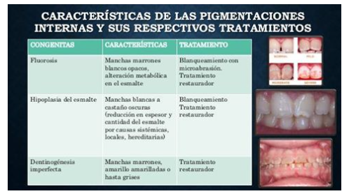 Hipoplasia del Esmalte