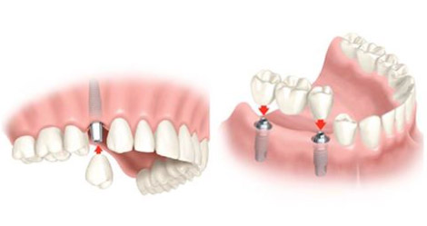 Implantes Dentales