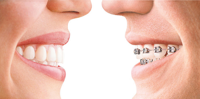 ¿Qué ventajas tiene la ortodoncia invisible?