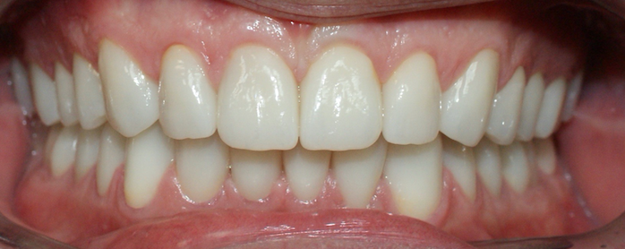 rehabilitación fija-ortodoncia previa-carillas dentales-fundas-dentclinic
