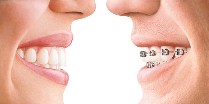 ortodoncia-invisible-invisalign-clinica-dental-mataro