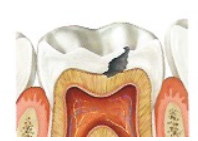 Alteraciones Bucales Embarazo · Caries Dental · Dentclinic · Mataró