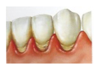 Alteraciones Bucales Embarazo · Enfermedad Periodontal · Dentclinic · Mataró