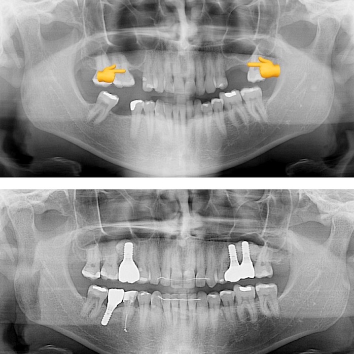 elevación de seno en clinica dental dentclinic-pacientes mataró