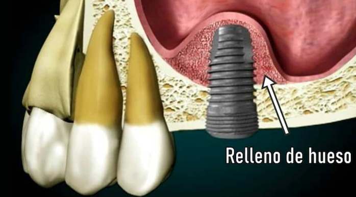 elevación de seno maxilar para colocación de implante dental