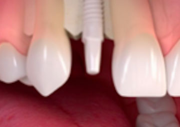 Implantes dentales cerámicos sin metal · Dentclinic · Mataró