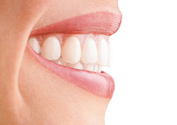 Ortodoncia Invisible Invisalign · Dentclinic · Mataró