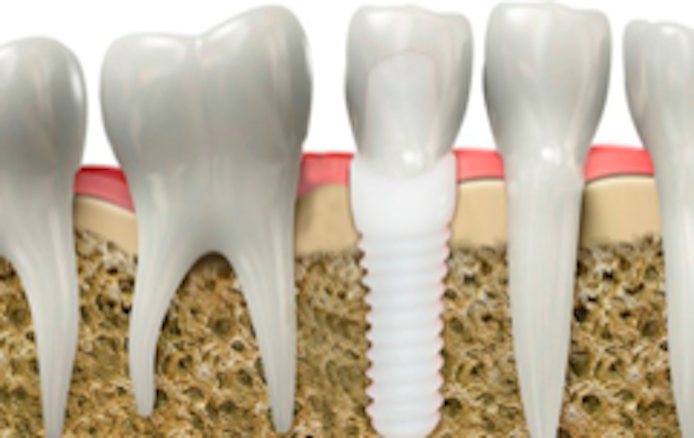 novedoso implante dental blanco
