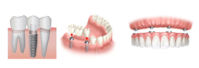 Implantes  · DentClínic · Clínica Dental en Mataró