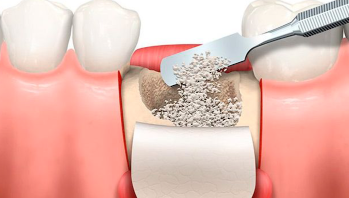 implantes dentales-necesidad injertos de hueso