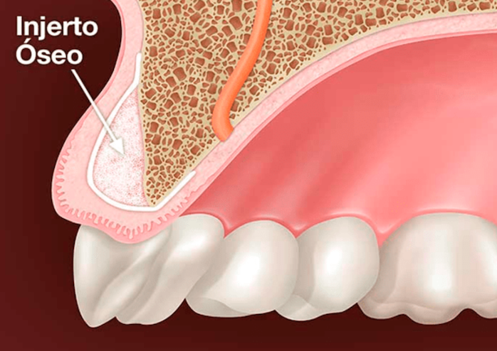 material de regeneración-injerto de hueso-membrana reabsorbible - implante dental-dentclinic