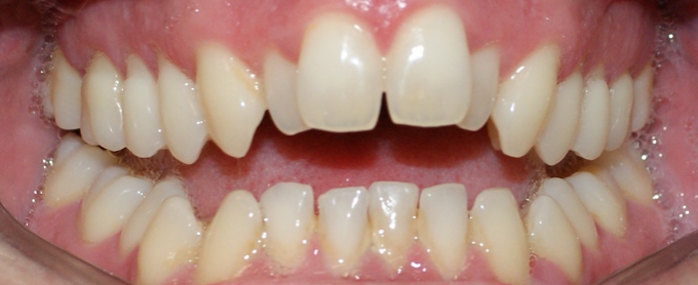 mordida abierta-ortodoncia invisible-carillas-dentclinic