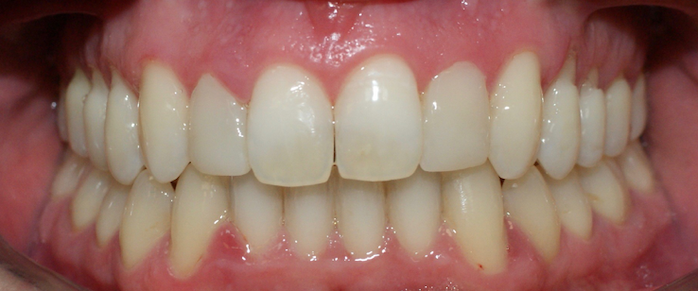 mordida abierta-invisalign-ortodoncia-carillas