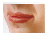 Problemática Oral Asociada al Piercing · Cicatrices Queloides