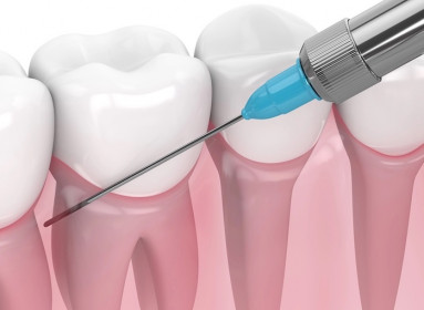 Elimina el miedo a las agujas en el dentista: Beneficios y avances de la anestesia