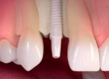 Implantes dentales Cerámicos de zirconio
