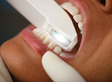 Ventajas del Escaner dental